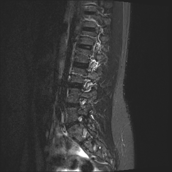 File:Normal lumbar spine MRI- 3 T (Radiopaedia 53280-59250 Sagittal STIR 8).jpg
