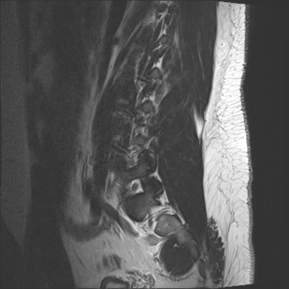 File:Normal lumbar spine MRI (Radiopaedia 47857-52609 Sagittal T2 3).jpg