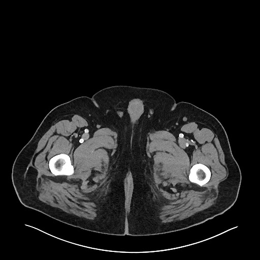 Obstructing sigmoid adenocarcinoma (Radiopaedia 58465-65619 A 181).jpg