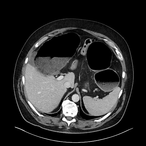 Obstructing sigmoid adenocarcinoma (Radiopaedia 58465-65619 A 40).jpg