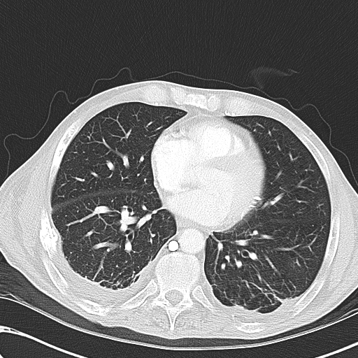 File:Obstructive superior vena cava tumor thrombus (Radiopaedia 28046-28306 Axial lung window 35).jpg