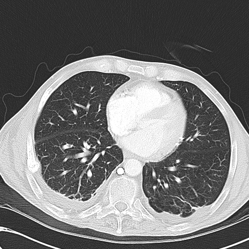 File:Obstructive superior vena cava tumor thrombus (Radiopaedia 28046-28306 Axial lung window 36).jpg