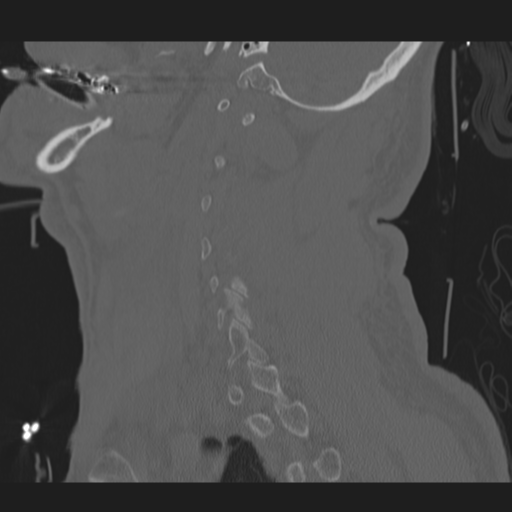 File:Occipital condyle fracture (Radiopaedia 33467-34517 Sagittal bone window 55).png