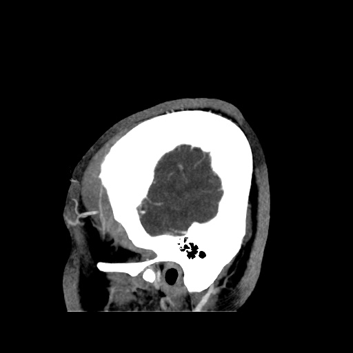 Occipital extradural hematoma simulating venous sinus thrombosis (Radiopaedia 46514-50964 D 8).jpg