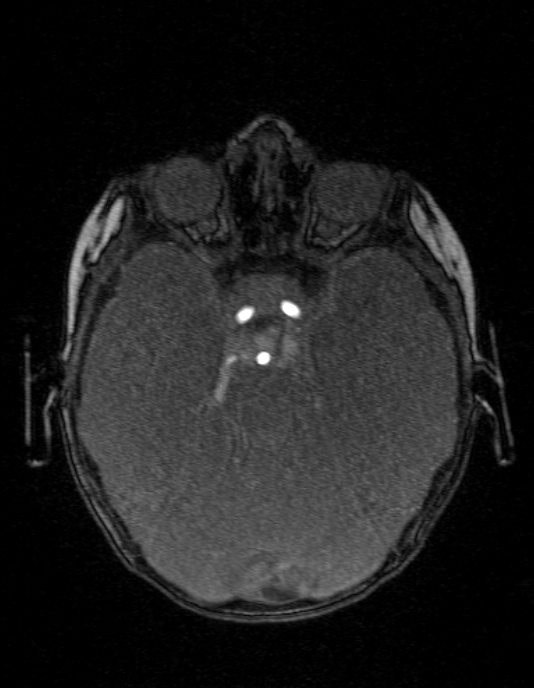 Occipital horn syndrome (Radiopaedia 14255-14129 MRA 52).jpg