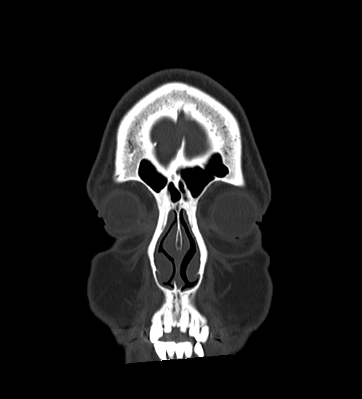 Occipital spur and Currarino type A atlas anomaly (Radiopaedia 87027-103285 Coronal bone window 30).jpg