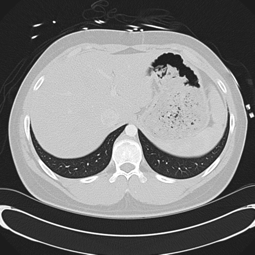 File:'Bovine' aortic arch (Radiopaedia 33554-34637 Axial lung window 58).png