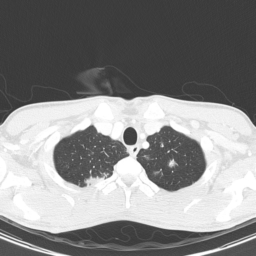 AIDS-related Kaposi sarcoma (Radiopaedia 85247-100811 Axial lung window 20).jpg