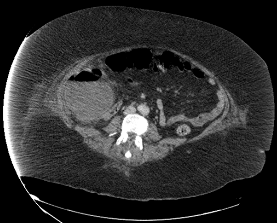 File:Abdominal abscess - pre and post percutaneous drainage (Radiopaedia 60209-67816 Axial 22).png