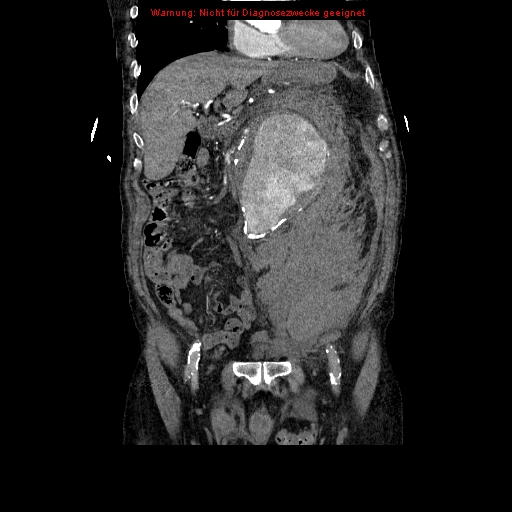 Abdominal aortic aneurysm- extremely large, ruptured (Radiopaedia 19882-19921 Coronal C+ arterial phase 40).jpg
