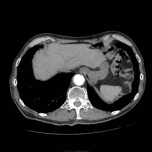 File:Abdominal aortic aneurysm (Radiopaedia 13341-13340 Axial C+ arterial phase 20).jpg