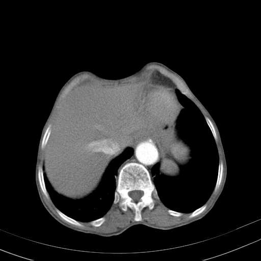 File:Abdominal aortic aneurysm (Radiopaedia 20827-20742 Axial C+ arterial phase 5).jpg