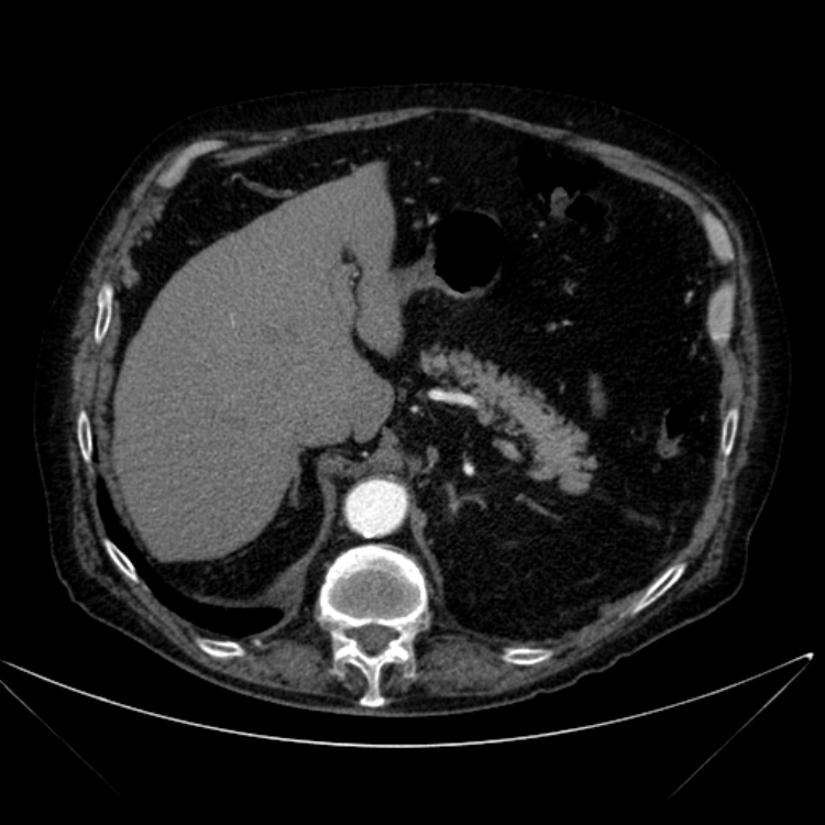 Abdominal aortic aneurysm (Radiopaedia 25855-26001 Axial C+ arterial phase 35).jpg