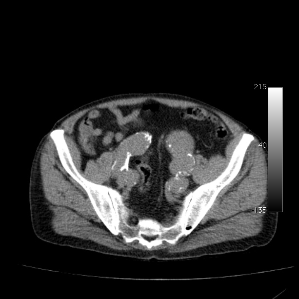 Abdominal aortic aneurysm (Radiopaedia 29248-29660 Axial non-contrast 45).jpg