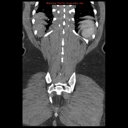 Abdominal aortic aneurysm (Radiopaedia 8190-9038 Coronal C+ arterial phase 113).jpg