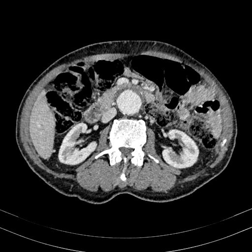 Abdominal aortic aneurysm (Radiopaedia 83581-98689 Axial C+ portal venous phase 51).jpg