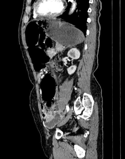 Abdominal aortic aneurysm (Radiopaedia 83581-98689 Sagittal C+ arterial phase 78).jpg