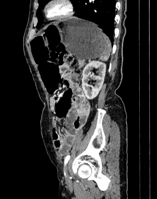 Abdominal aortic aneurysm (Radiopaedia 83581-98689 Sagittal C+ arterial phase 94).jpg