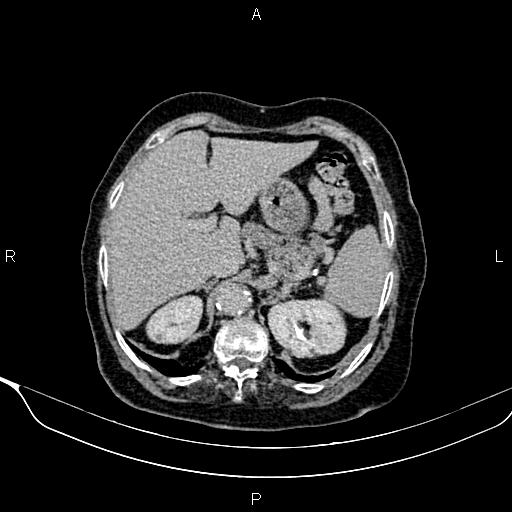 Abdominal aortic aneurysm (Radiopaedia 85063-100606 Axial C+ delayed 14).jpg