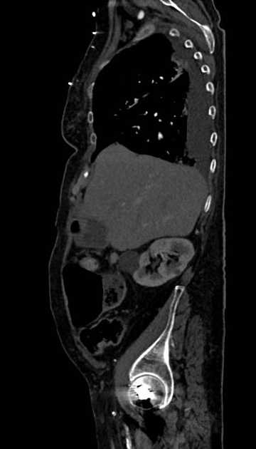 Abdominal aortic aneurysm with thrombus fissuration (Radiopaedia 73192-83919 Sagittal C+ arterial phase 110).jpg