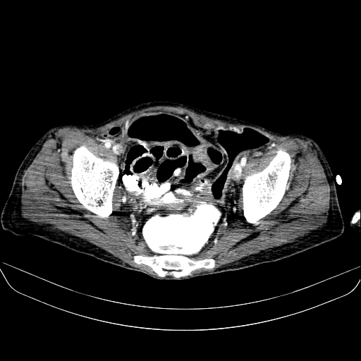 File:Abdominal collection due to previous cecal perforation (Radiopaedia 80831-94320 Axial C+ portal venous phase 179).jpg
