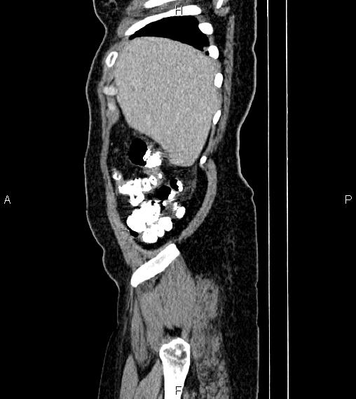 Abdominal lymphoma with sandwich sign (Radiopaedia 84378-99704 Sagittal C+ portal venous phase 4).jpg