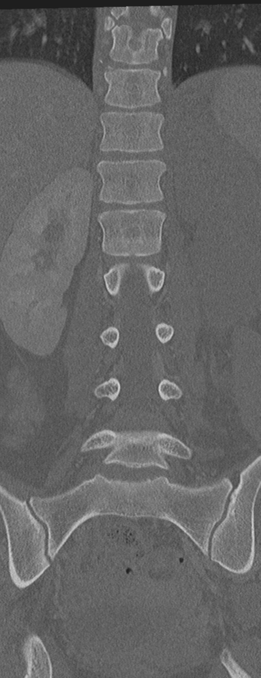 Abdominal multi-trauma - devascularised kidney and liver, spleen and pancreatic lacerations (Radiopaedia 34984-36486 Coronal bone window 37).png