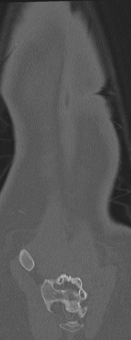 Abdominal multi-trauma - devascularised kidney and liver, spleen and pancreatic lacerations (Radiopaedia 34984-36486 Coronal bone window 69).png