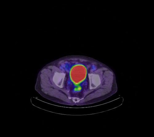 Abdominal wall metastasis from colorectal carcinoma (Radiopaedia 31016-31719 Axial 30).jpg
