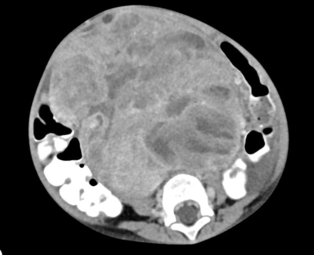 Abdominopelvic rhabdomyosarcoma (Radiopaedia 78356-90984 Axial C+ portal venous phase 107).jpg