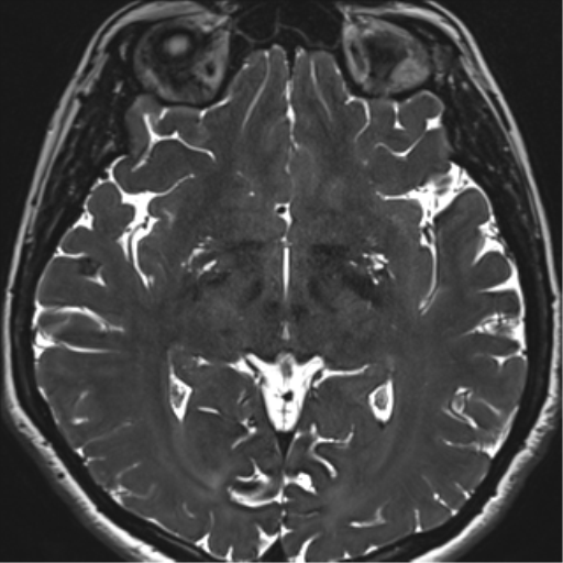 Abducens nerve palsy (Radiopaedia 51069-56648 Axial T2 fat sat 85).png