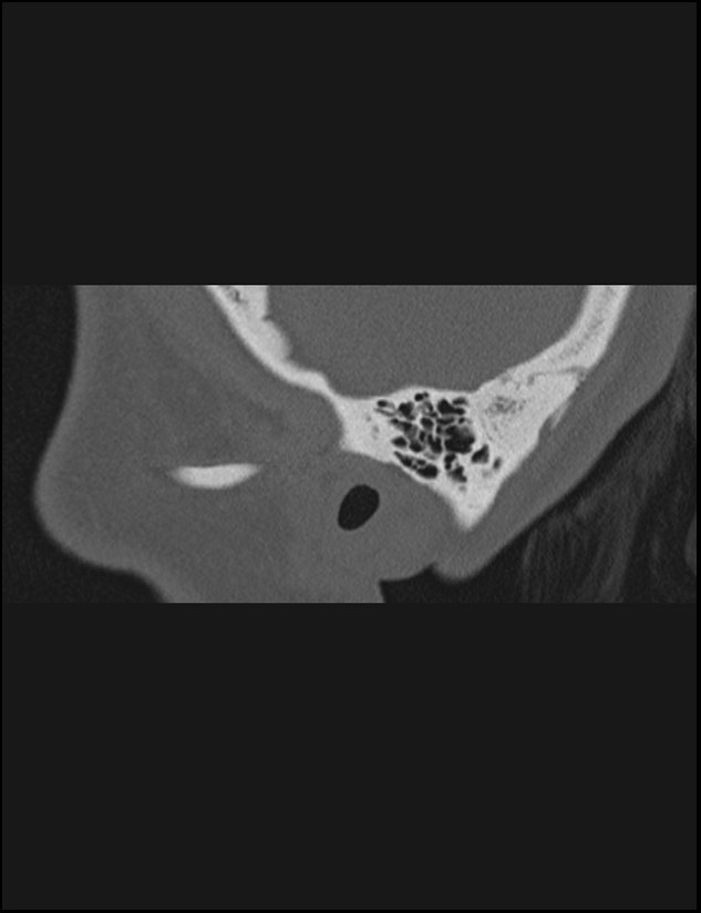 Aberrant right internal carotid artery (Radiopaedia 65191-74198 Sagittal non-contrast 13).jpg