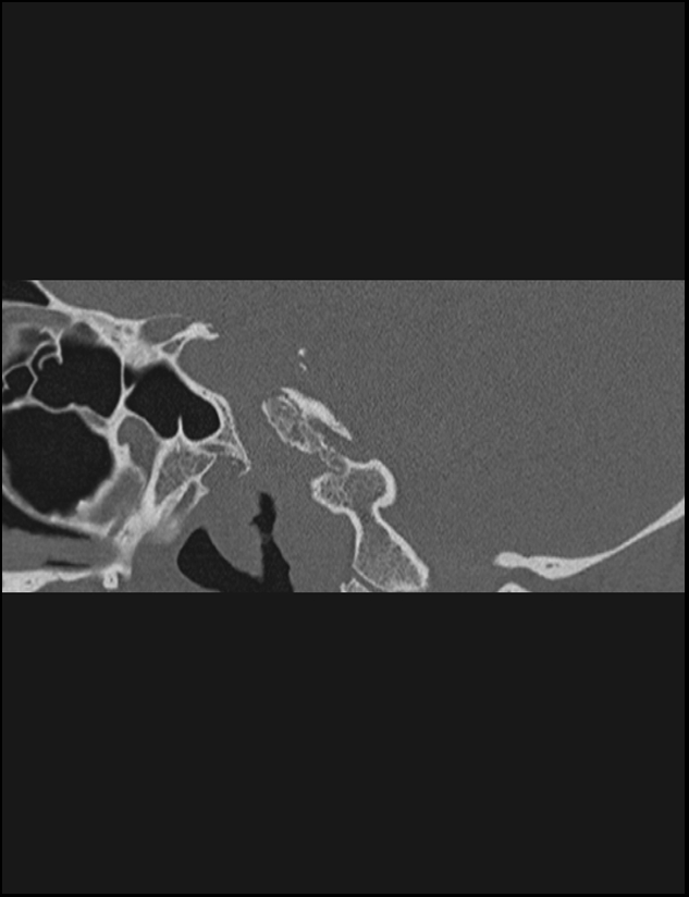 Aberrant right internal carotid artery (Radiopaedia 65191-74198 Sagittal non-contrast 85).jpg