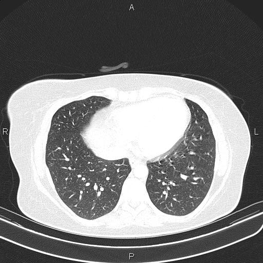 File:Aberrant right subclavian artery (Radiopaedia 87334-103629 Axial lung window 47).jpg