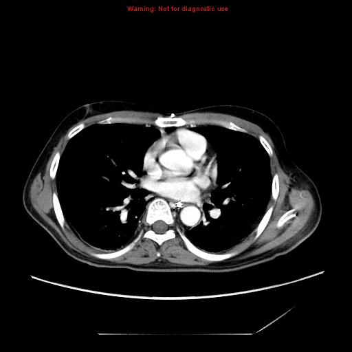 File:Aberrant right subclavian artery (Radiopaedia 9379-10071 Axial C+ arterial phase 35).jpg