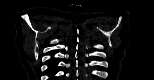 Accesory rib joint (Radiopaedia 71987-82452 Coronal bone window 85).jpg