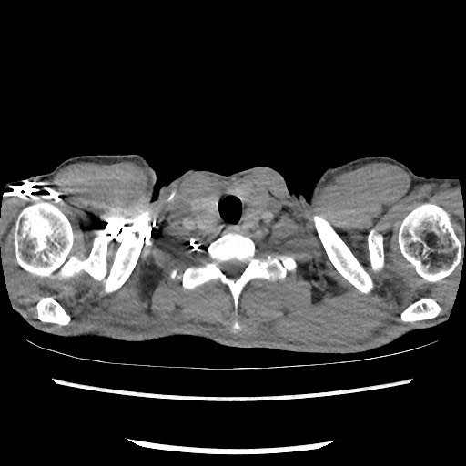 Accessory left horizontal fissure with lingular pneumonia (Radiopaedia 53763-59843 Axial C+ CTPA 3).jpg