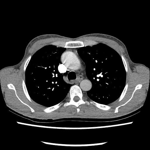 File:Accessory left horizontal fissure with lingular pneumonia (Radiopaedia 53763-59843 Axial C+ CTPA 34).jpg