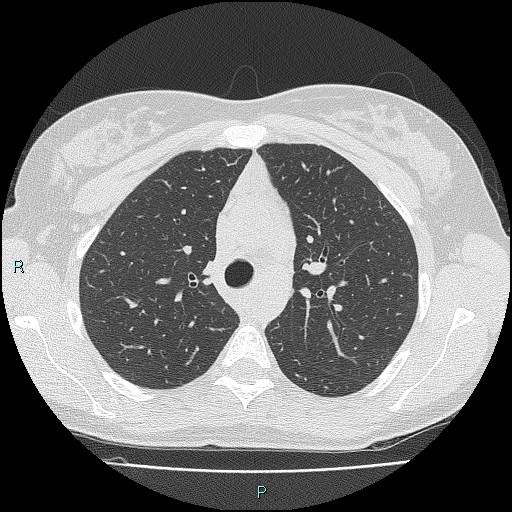 File:Accidental foreign body aspiration (seamstress needle) (Radiopaedia 77740-89983 Axial lung window 22).jpg