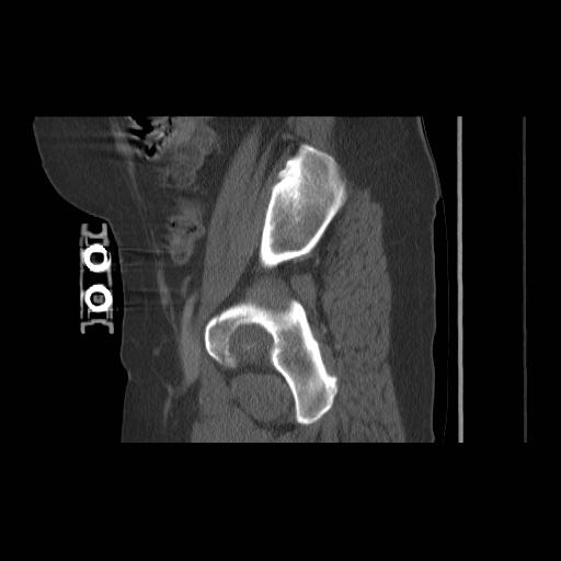 File:Acetabular fracture (Radiopaedia 13193-13212 Sagittal bone window 27).jpg