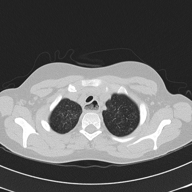 Achalasia (Radiopaedia 14946-14878 Axial lung window 7).jpg