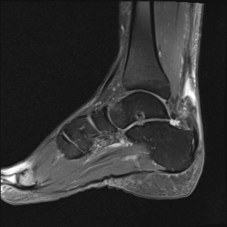File:Achilles tendon tear (Radiopaedia 77615-89819 Sagittal PD fat sat 11).jpg