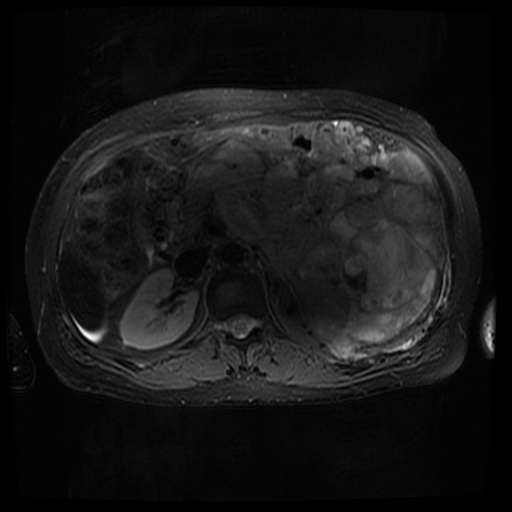 Acinar cell carcinoma of the pancreas (Radiopaedia 75442-86668 Axial T2 fat sat 35).jpg