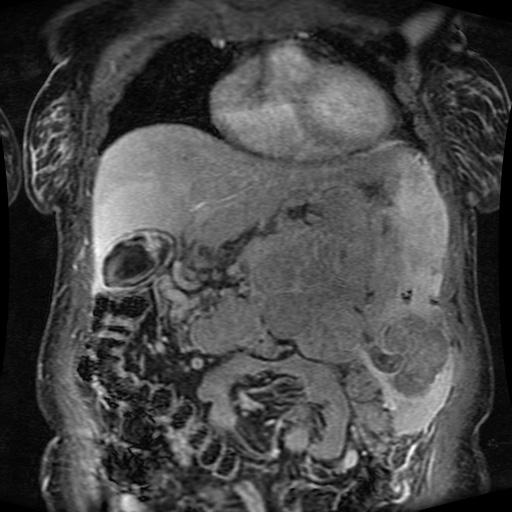 Acinar cell carcinoma of the pancreas (Radiopaedia 75442-86668 Coronal T1 C+ fat sat 132).jpg