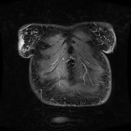 Acinar cell carcinoma of the pancreas (Radiopaedia 75442-86668 Coronal T1 C+ fat sat 175).jpg