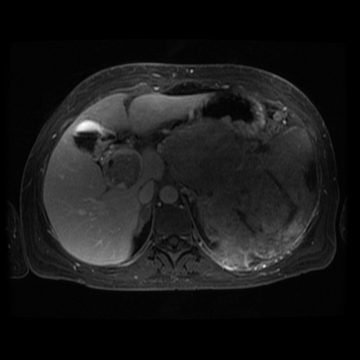 Acinar cell carcinoma of the pancreas (Radiopaedia 75442-86668 D 87).jpg