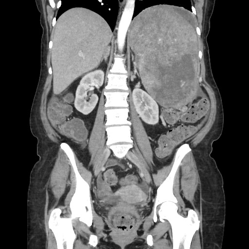 Acinar cell carcinoma of the pancreas (Radiopaedia 75442-86669 Coronal C+ portal venous phase 78).jpg