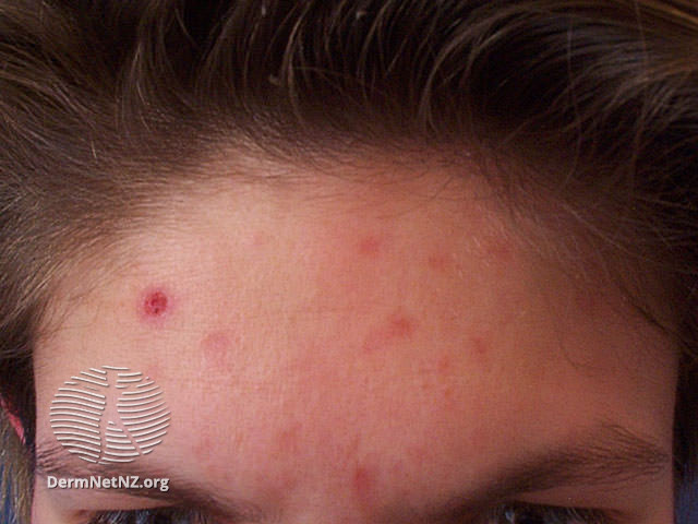 File:Acne excorieé (DermNet NZ acne-acne-excorie).jpg