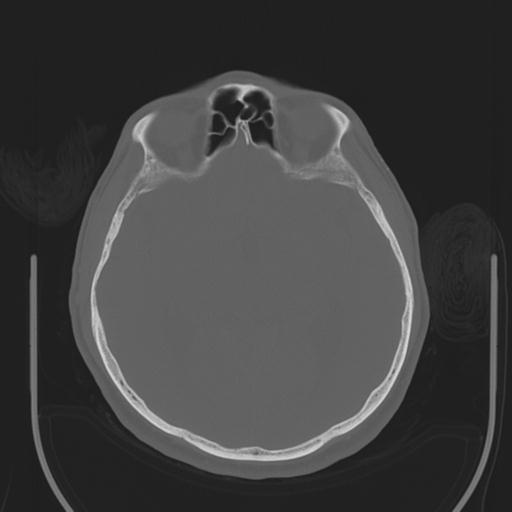 File:Acoustic schwannoma (Radiopaedia 29488-29982 AXIAL BONE THICK non-contrast 22).jpg