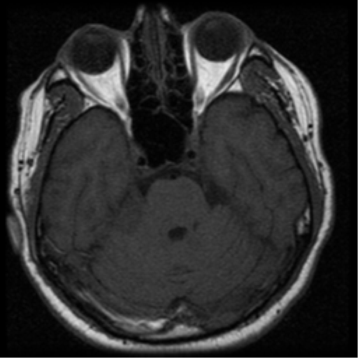File:Acoustic schwannoma (Radiopaedia 33045-34060 Axial T1 10).png